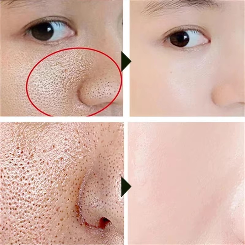살리실산 모공 축소 크림 빠른 모공 축소 블랙헤드 제거 - Skincare Salicylic Acid 리뷰 및 가격